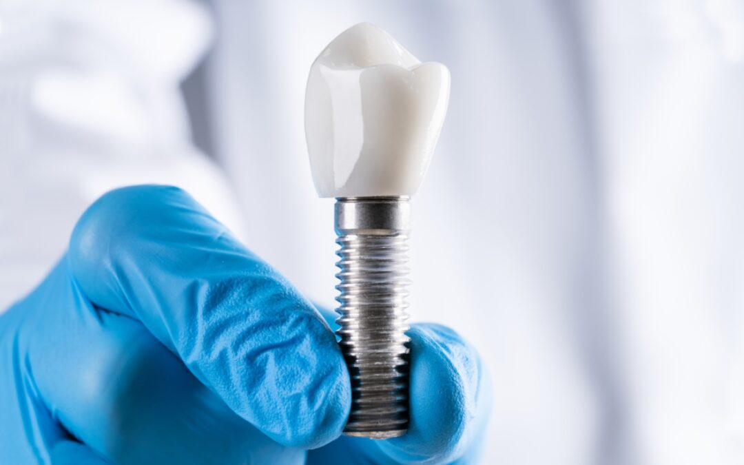 Am I a Good Candidate for Dental Implants?