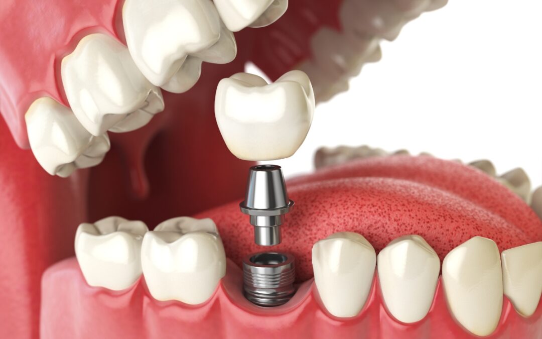Why You Should Consider Dental Implants in Webster for Tooth Replacement
