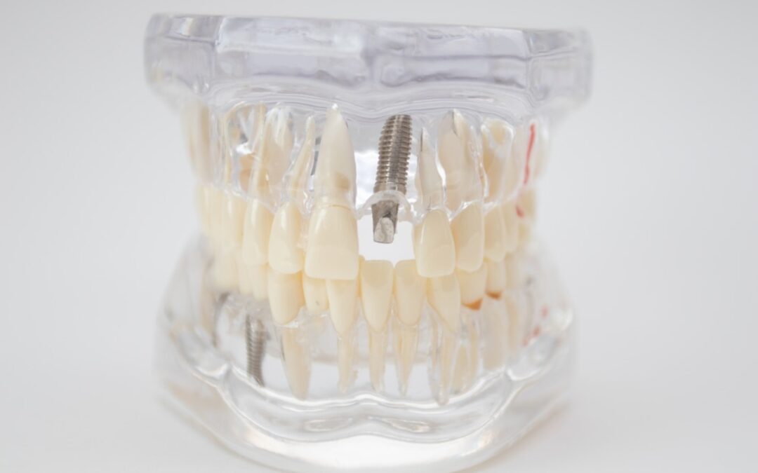 How to Maintain Healthy Gums for Long-Lasting Dental Implants