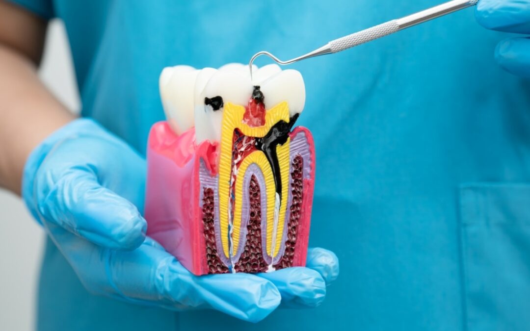 How a Root Canal Can Stop the Pain and Save the Tooth