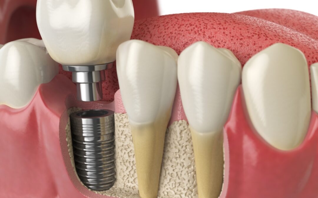 How to Maintain Good Oral Hygiene With Dental Implants