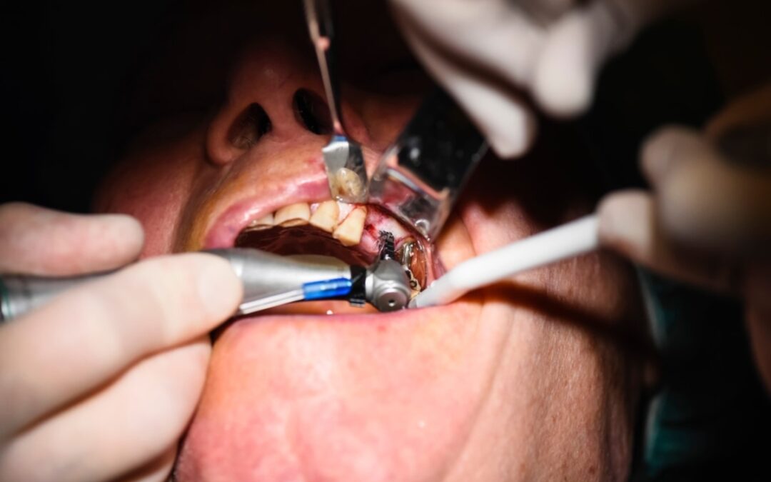 How Oral Surgery Can Help Fix a Gummy Smile?