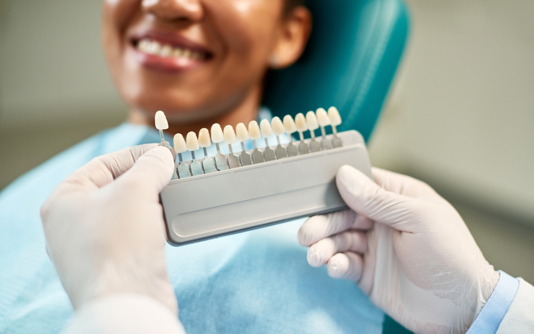 Why Are Minimal-Prep Veneers Becoming So Popular?