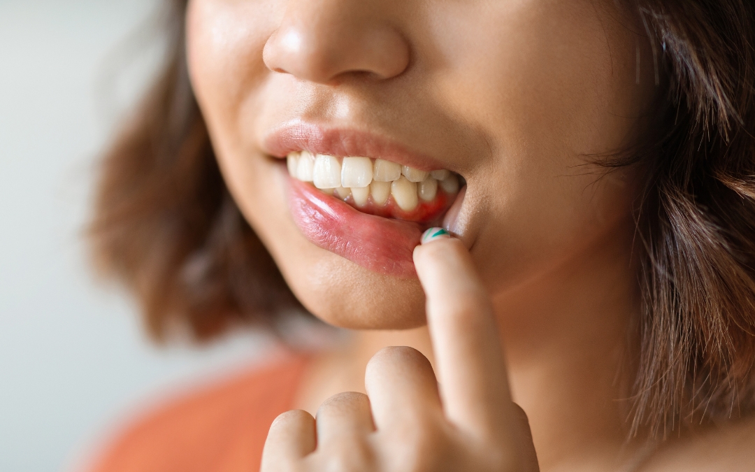 What Is the Best Antibiotic for Gum Infection?