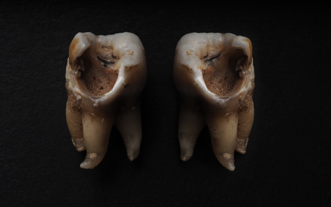 What Should You Do If a Decayed Tooth Falls Out?